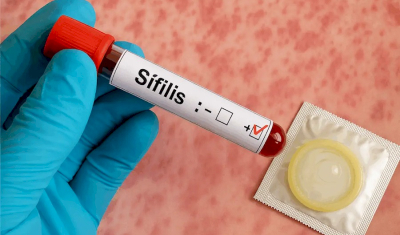 Alarmante aumento de casos de sífilis en Buenos Aires